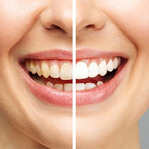 Teeth whiting